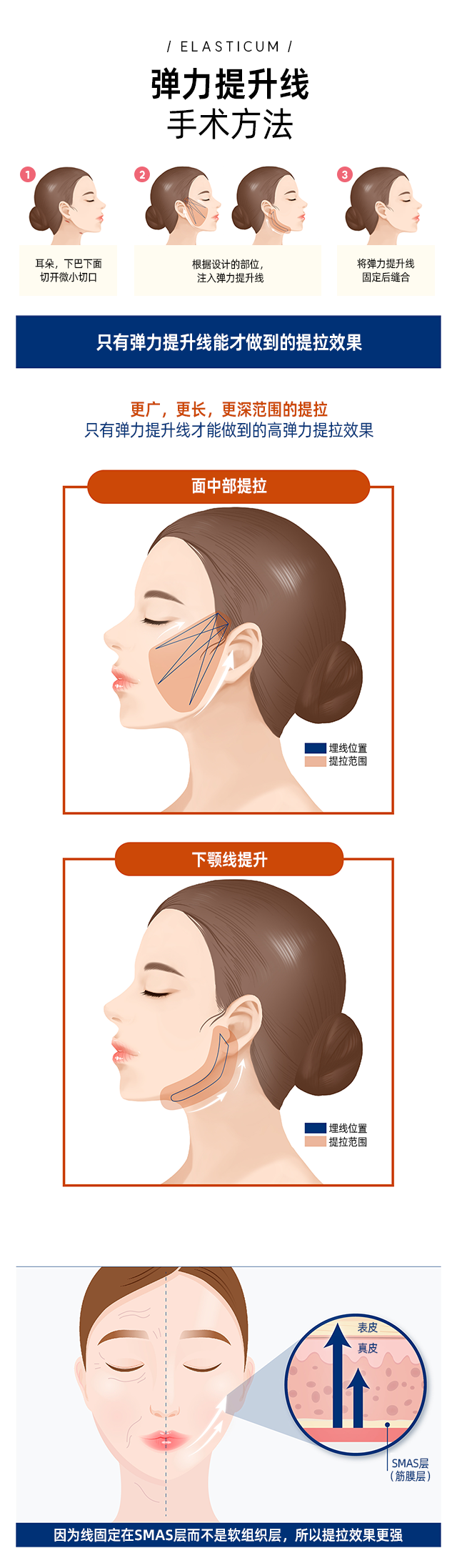 엘라스티꿈 수술방법 - 1.양쪽 귀 밑, 턱 밑쪽에 작은 절개창을 만듭니다. 2.디자인된 부위를 따라서 실을 주입 후 실의 돌기가 피부에 잘 걸리도록 합니다. 3.실을 절개창에 고정하고 피부를 봉합합니다.