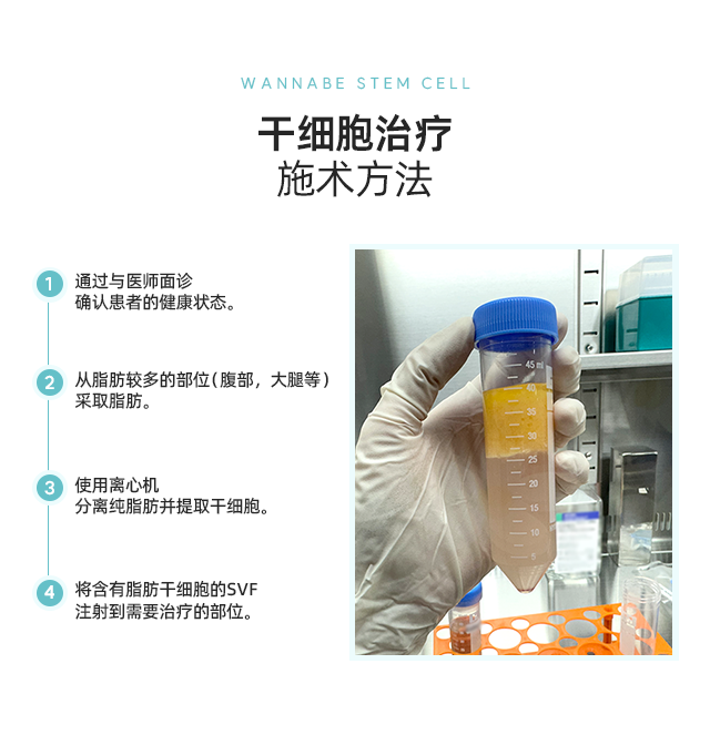 干细胞脂肪移植施术方法 - 1. 通过与医师面诊设计面部需要脂肪移植的部位。2. 从脂肪较多的部位（腹部，大腿等）采取脂肪。3. 使用离心机分离纯脂肪并提取干细胞。4. 将含有脂肪干细胞的SVF与脂肪一起注射到需要移植的部位。